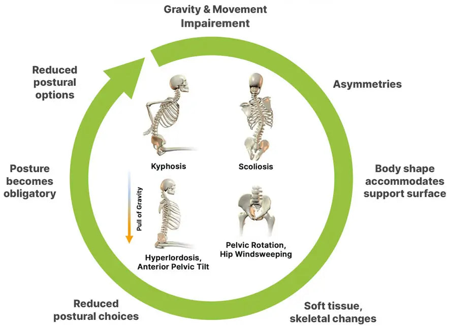 Diagram showing the progression of postural issues, with arrows indicating gravity and movement improvement.